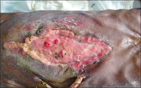 Shows closure of the laparostomy incision with the formation of entero-atmospheric fistula.